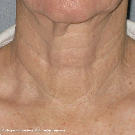 woman's neck after ultherapy