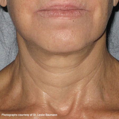 woman's neck after ultherapy
