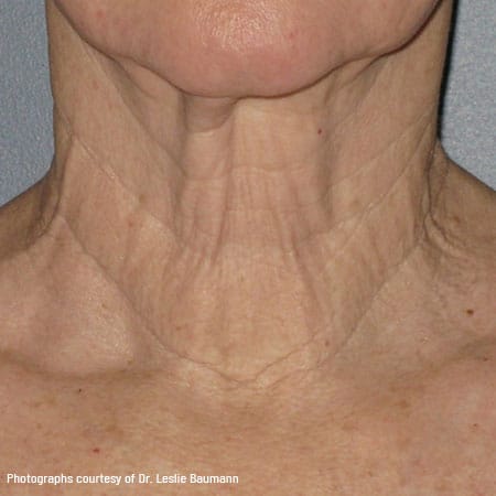woman's neck before ultherapy