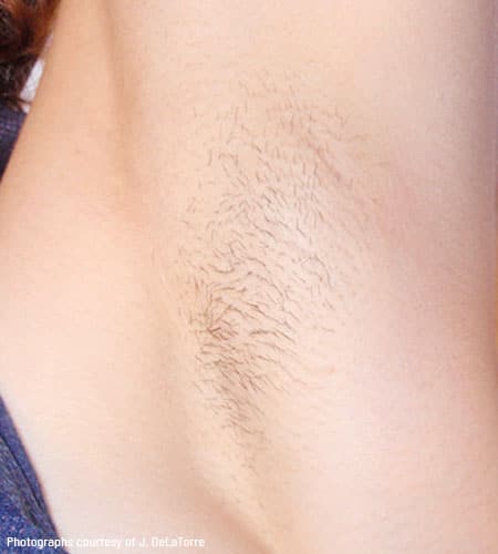man's armpit after vectus