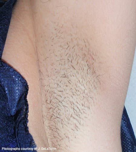 man's armpit before vectus