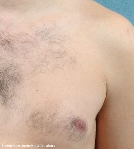 man's chest before vectus