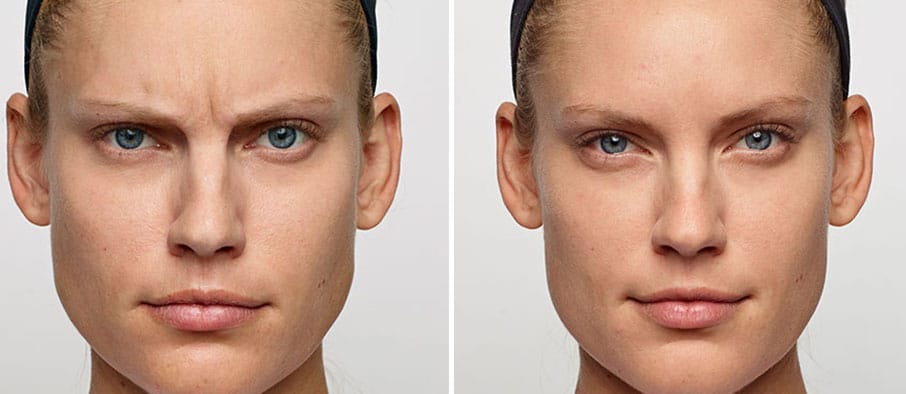 woman with relaxed face vs. wrinkles