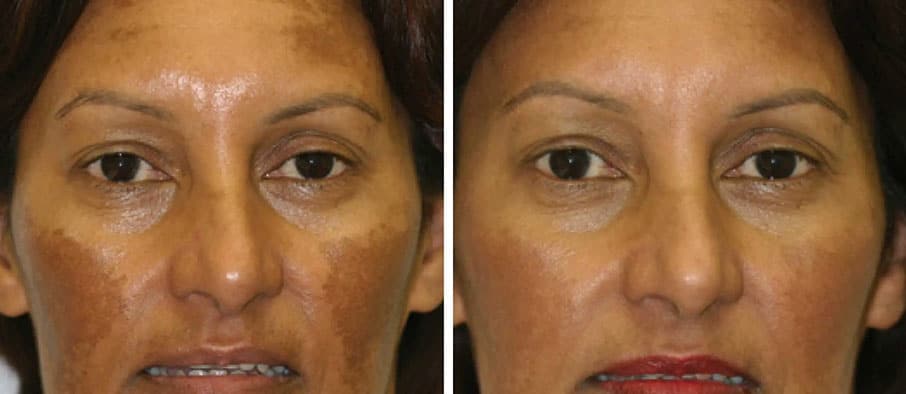 melasma treatment results